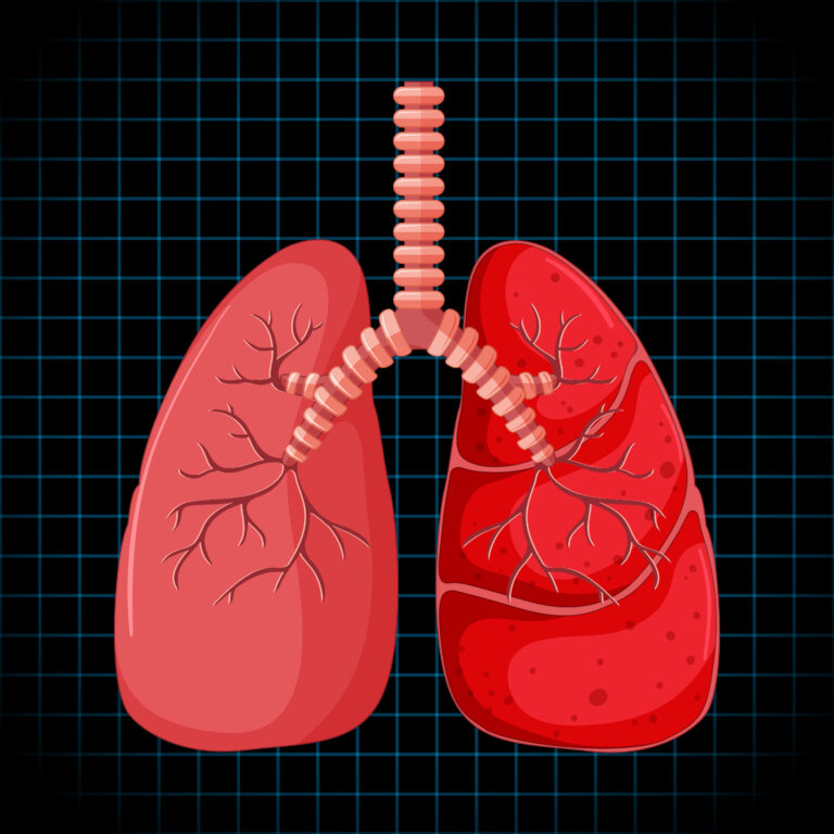 Pulmonary Artery Banding (PAB)