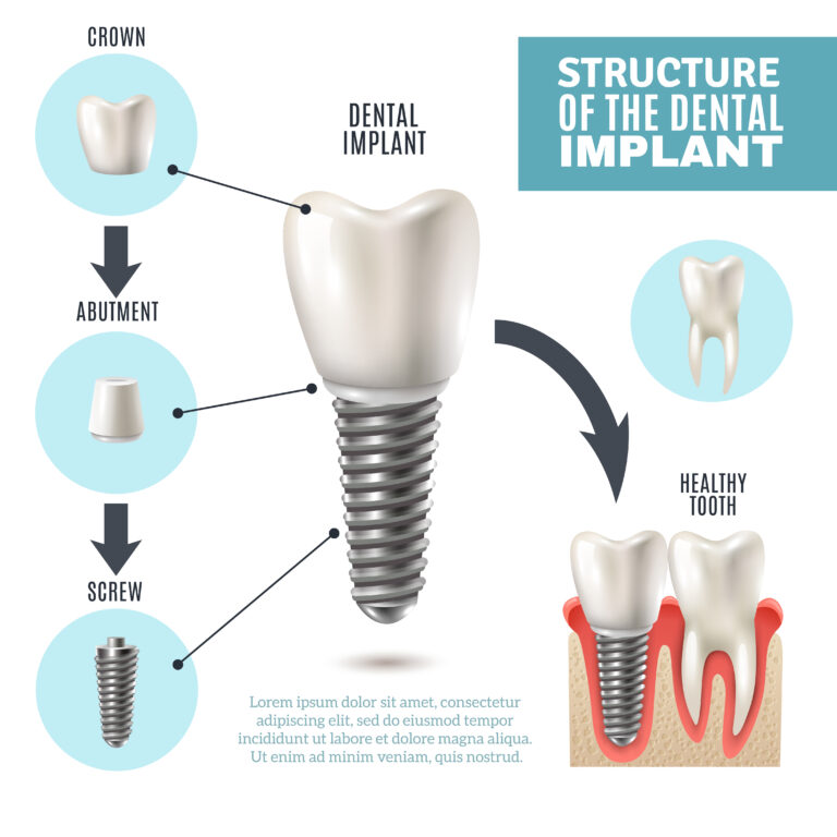 Dental Implant