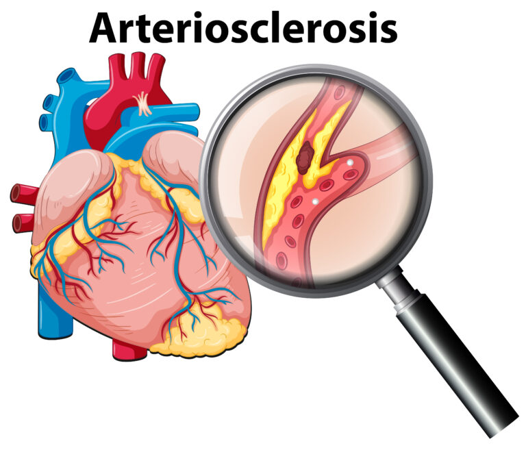 Patent Ductus Arteriosus (PDA) Closure