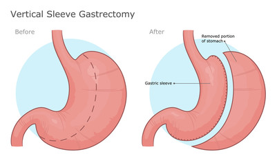 Sleeve Gastrectomy