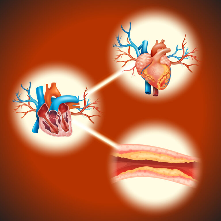 Minimally Invasive Direct Coronary Artery Bypass (MIDCAB)