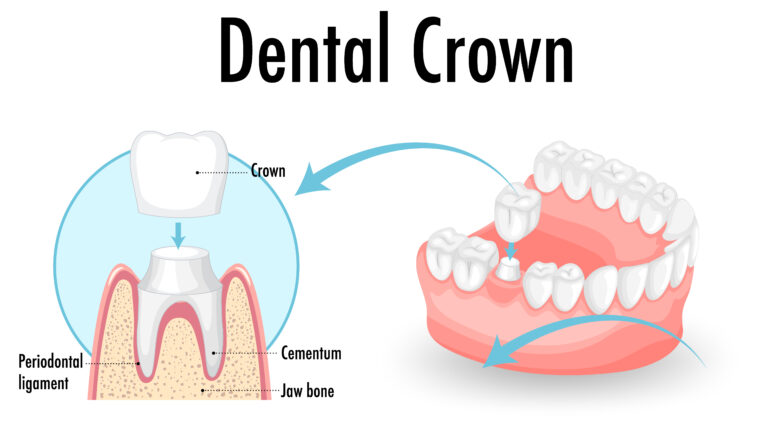 Dental Crown