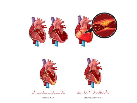 Acute Decompensated Heart Failure