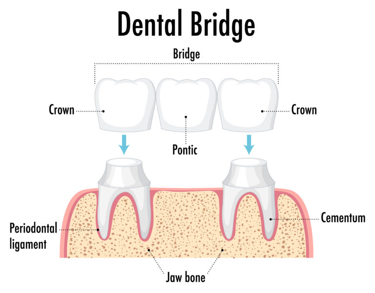 Dental Bridge