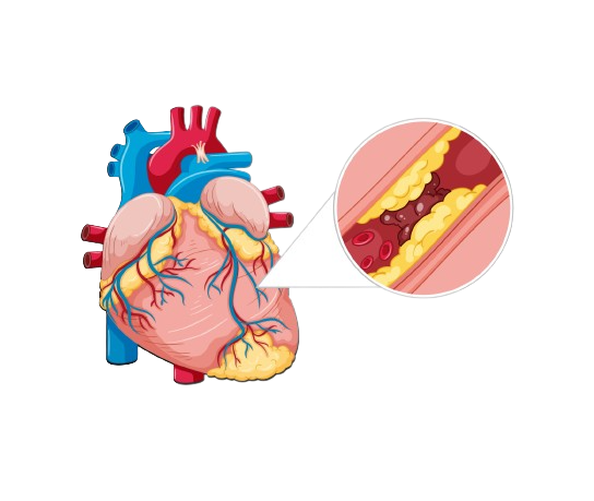 Atherosclerosis Treatment