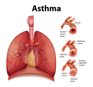 Cardiac Asthma