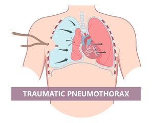 Pneumothorax Treatment