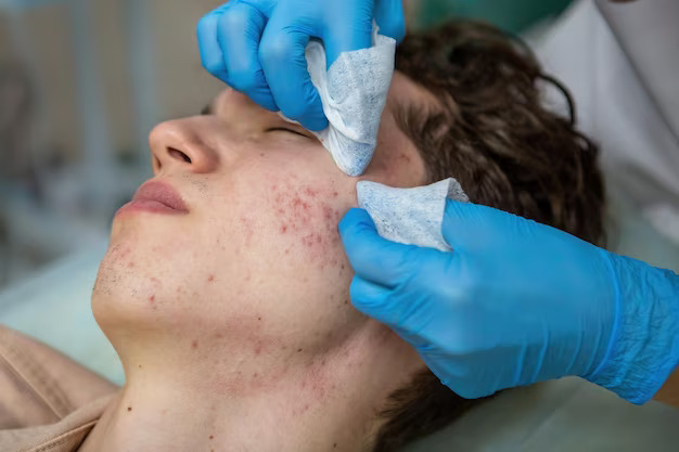 Acne Scar Treatment