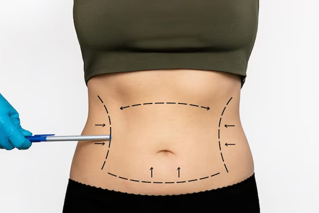 Liposuction