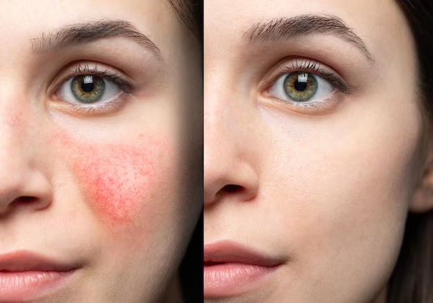 Rosacea Treatment