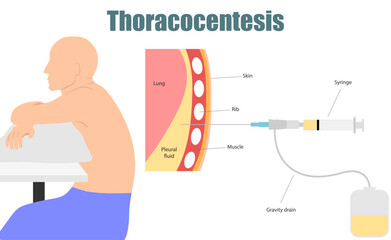 Thoracentesis