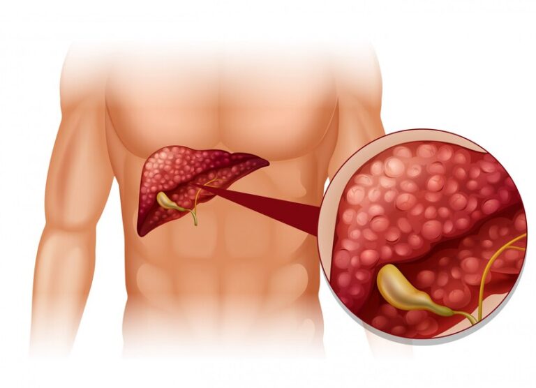 Liver Resection